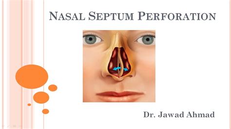 Nasal Septum Perforation Explained For Medical Students Youtube