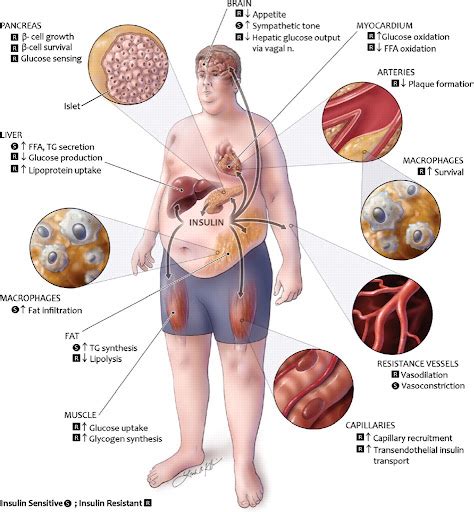 Sindromul Metabolic Diabetul Zaharat Si Bolile Ficatului Andrei