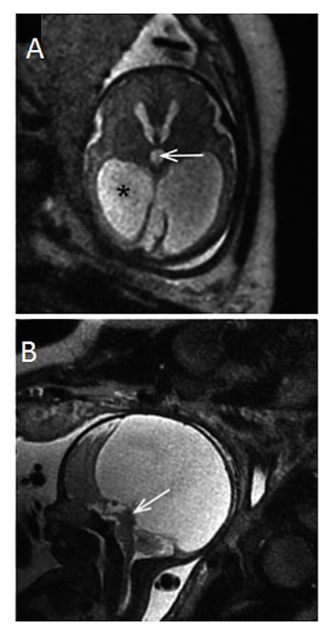 Cureus Fetal Magnetic Resonance Imaging Of Malformations Associated