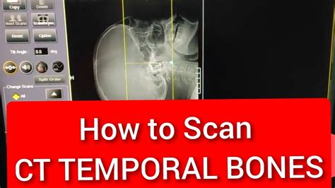 How To Scan Ct Temporal Bones Youtube