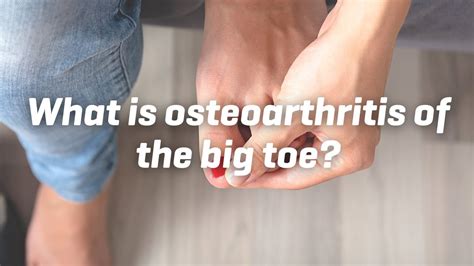 What Is Osteoarthritis Of The Big Toe Youtube