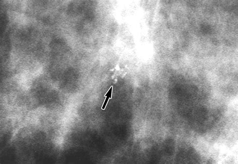 Stereotactic Biopsy Of The Breast Using An Upright Unit A Vacuum