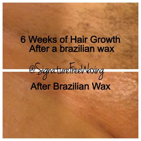 Top Photo 6 Weeks After Receiving A Brazilian Wax At Signature Free