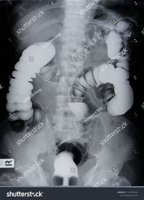 Barium Enema Radiology Double Contrast Stock Photo 1124759249