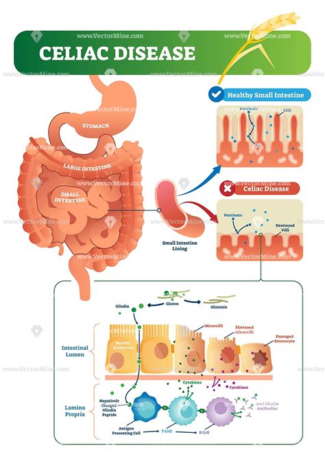 Celiac Disease Biological Anatomy Vector Illustration Diagram Celiac
