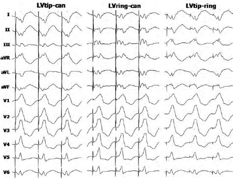 Twelve Lead Ecg With Unipolar Stimulation From Tip And Ring