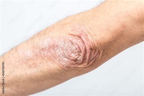 Acute Psoriasis On The Elbows Of A Man Is An Autoimmune Incurable