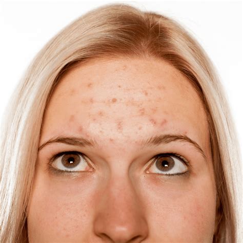 Discover Our Acne Treatment In Reading Crysallis Skin Clinic Latest