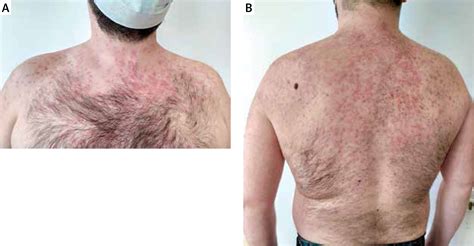 Maculopapular Rash In Covid 19 Patient Treated With Lopinavirritonavir