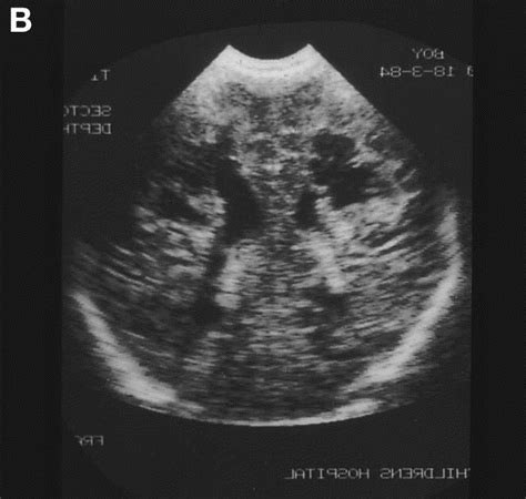 Germinal Matrixintraventricular Hemorrhage In The Premature Newborn