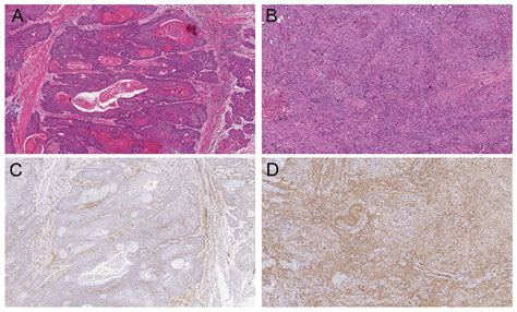Stromal Myofibroblasts In Potentially Malignant And Malignant Lesions