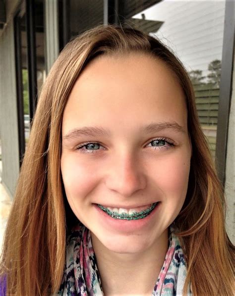 Pin By The Roc On Girls In Braces In Braces Girls Beautiful Smile Orthodontics