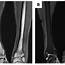 Plain MRI View Of The Left Lower Leg T1 Enhanced A Shows Low 