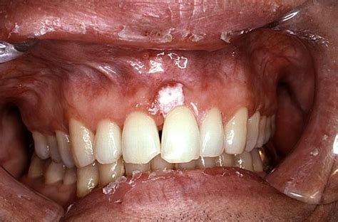 What Does Oral Cancer Look Like