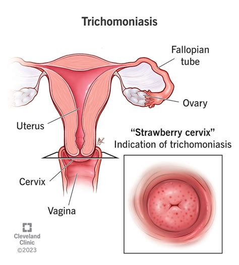 Unveiling Trichomoniasis Causes Symptoms Treatment And Prevention
