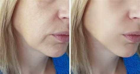 Voluma In Cheeks Before And After Pea Vie