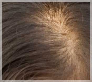 It's the leading cause of hair loss in women and generally begins between the ages of 12 to 40. Women's Hair Loss 101: Types of hair loss in women