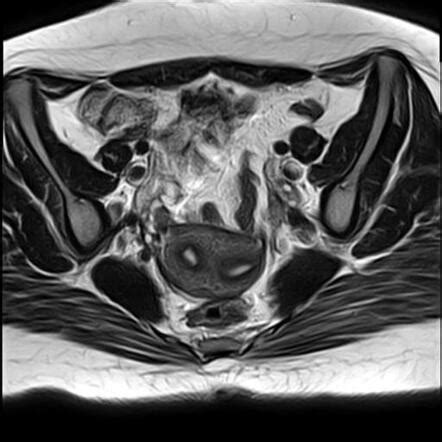 Complete Septate Uterus Image Radiopaedia Org