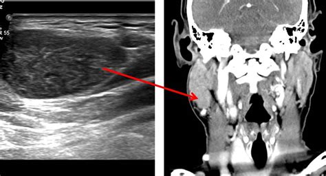 Warthins Tumour Of Parotid Gland Radiology Cases