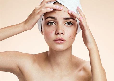 Advanced Acne Tips And Tricks We Intend To Make It Completely Clear