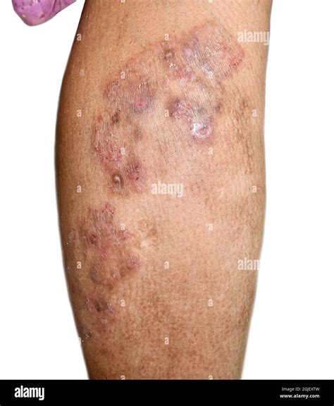 Dark Skin Eczema Hi Res Stock Photography And Images Alamy