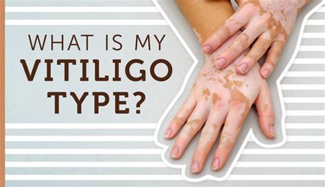 Vitiligo Clinical Trial Resource Center Myvitiligoteam