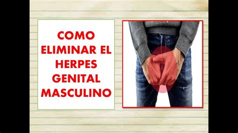 Como ELIMINAR El HERPES GENITAL MASCULINO Como CURAR El Herpes