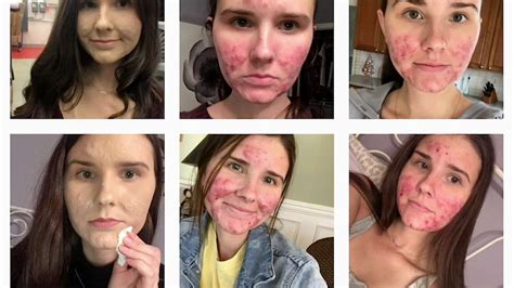 Instagram Empowers Girl To Embrace Her Cystic Acne Rtm Rightthisminute