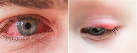 How To Tell The Difference Between A Stye And Pink Eye Velocity