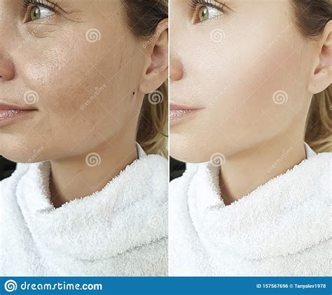 Woman Face Wrinkles Before And After Treatment Stock Photo Image Of