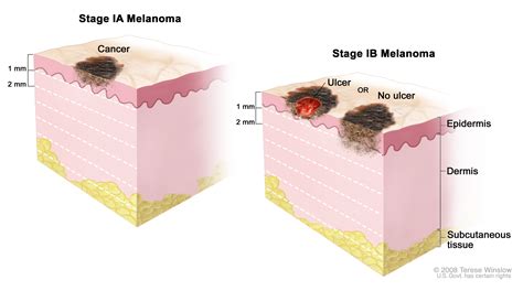 Melanoma Skin Cancer Treatment