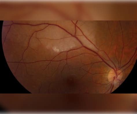 Branch Retinal Artery Occlusion In Patient With Vision Loss And