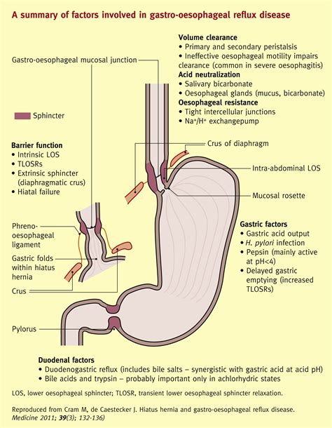 Hiatus Hernia And Gastro Oesophageal Reflux Disease Medicine
