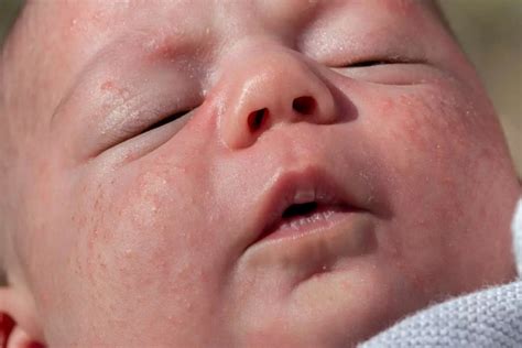 Erythema Toxicum A Guide To Understanding The Common Newborn Skin