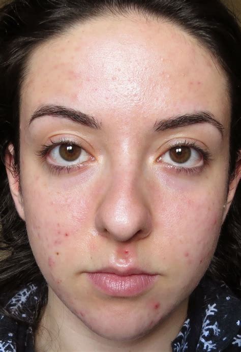 My Skins Journey Week 21 Banish Acne Scars