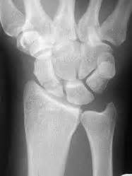 Scaphoid Fracture - Hand - Orthobullets.com