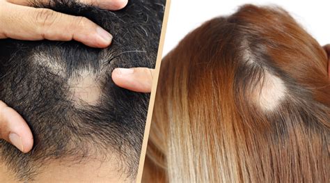Share Main Causes Of Hair Loss Super Hot Vova Edu Vn