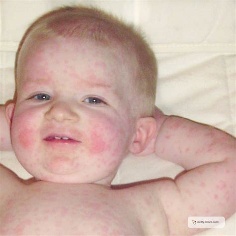 Slapped Cheek Syndrome Signs Symptoms And Treatments