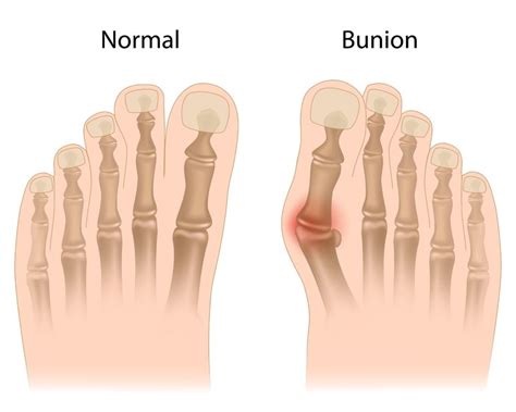 Bunions Causes Symptoms And Treatments North Central Surgical Hospital
