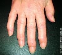 Arthrose finger ist eine form von gelenkverschleiß, die viel mehr frauen als männer betrifft. Arthrosen des Handgelenks und der Fingergelenke