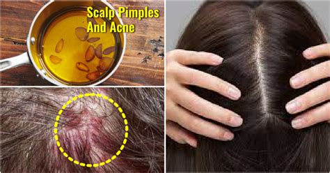 10 Ways To Get Rid Of Scalp Acne Due To Dandruff
