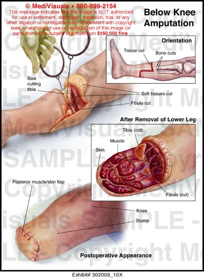 Below Knee Amputation Anatomy