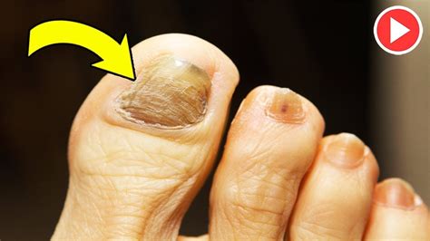 How to use vinegar for toenail fungus. Fight Nail Fungus With Apple Cider Vinegar And Baking Soda ...