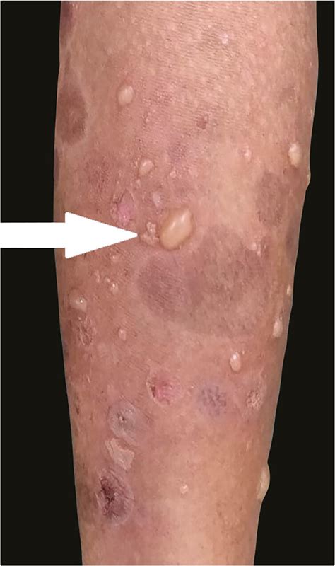 Clinical Image Of Bullous Pemphigoid Like Lesions Over Normal And