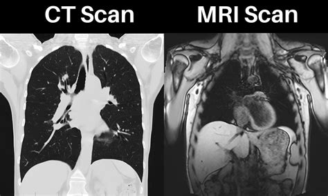 CT Scans VS MRI Scans What Are The Differences Between Them