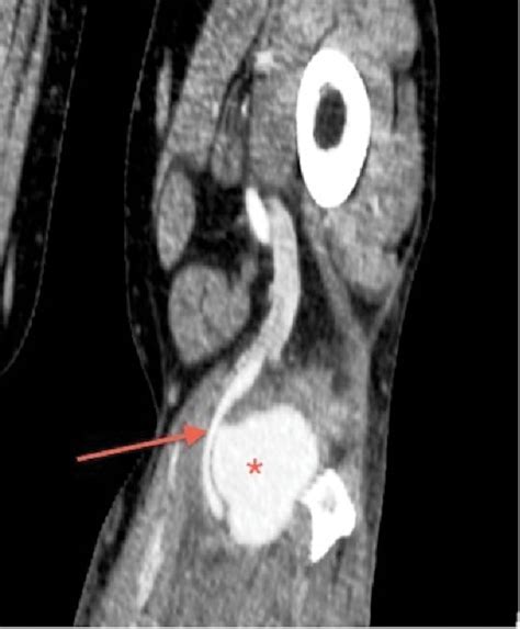 Ct Angiogram Of The Left Leg Coronal Section Shows Popliteal