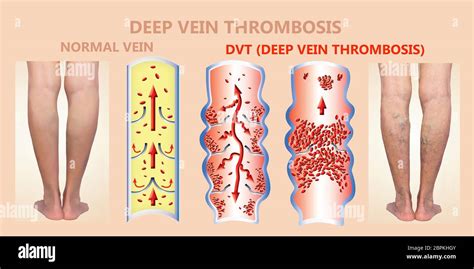 Deep Vein Thrombosis Or Blood Clots Embolus Structure Of Normal And