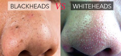 Tidak dinafikan masalah blackhead dan whitehead memang merimaskan. 9 Cara Semulajadi Hilangkan 'Blackhead' & 'Whitehead ...
