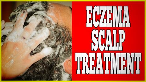 Eczema Scalp Treatment 3 Shocking Eczema Scalp Treatment Youtube