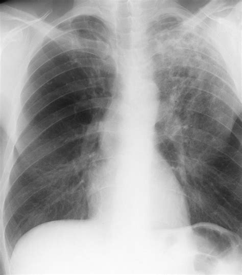 Old And New Tuberculosis X Ray Photograph By